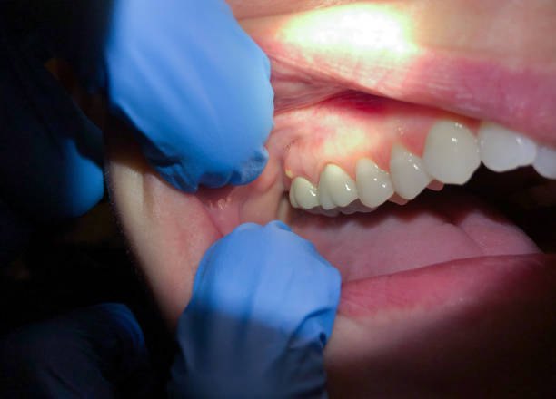 Best Emergency Denture Repair in Weleetka, OK